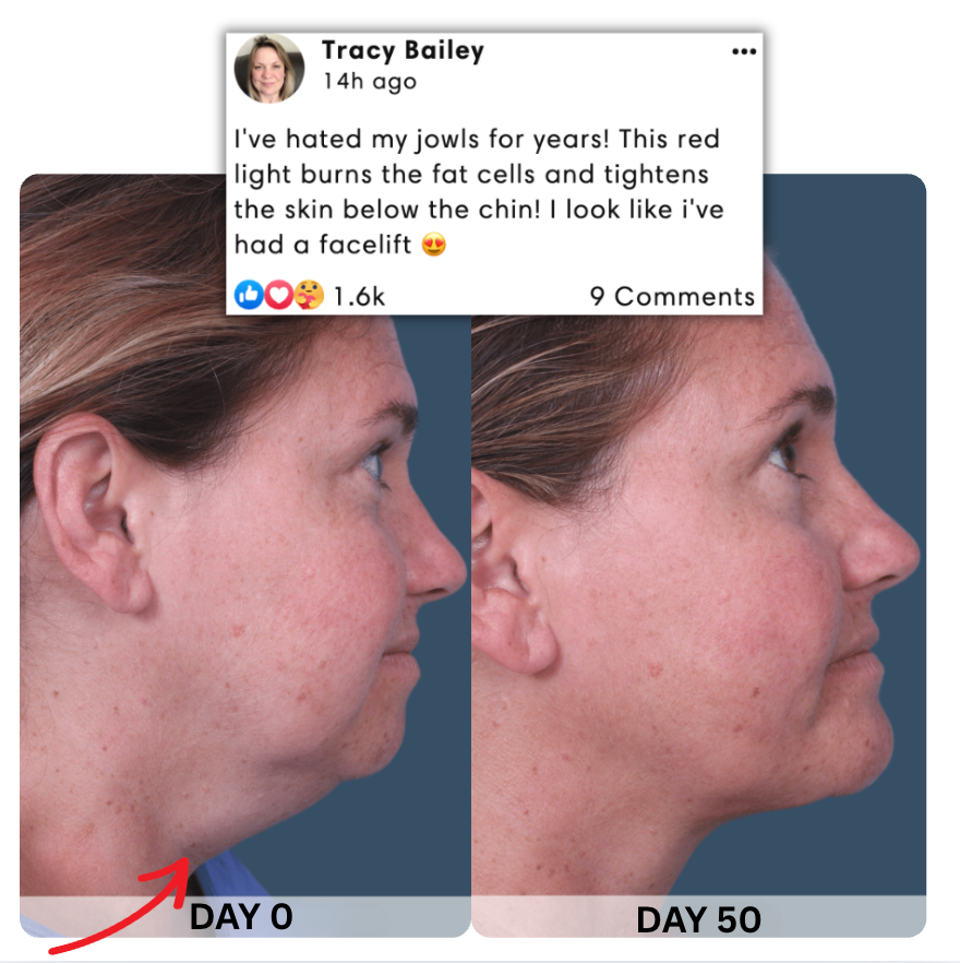 Luxole™ Chin Therapy Belt