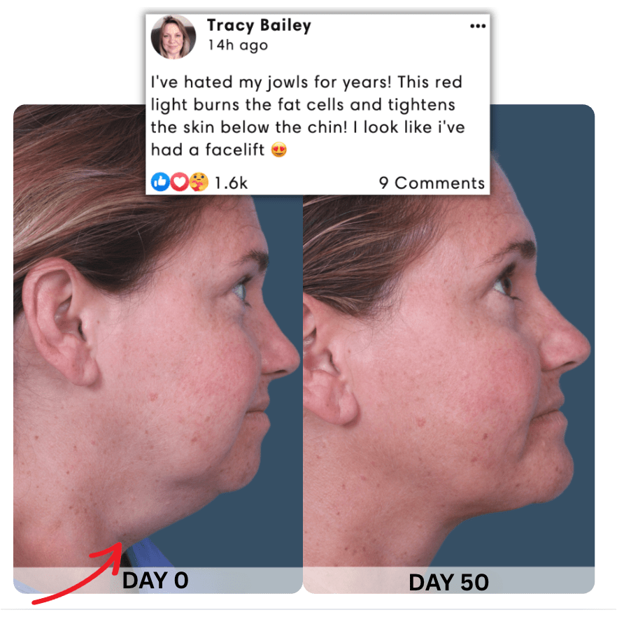 Luxole™ Chin Therapy Belt